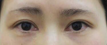 他院目頭切開術後修正の症例写真