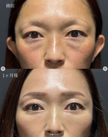 CLINIC Wの目元・クマ・眉下・涙袋整形の症例写真