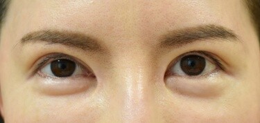他院目頭切開術後の症例写真[アフター]