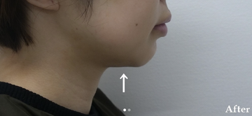 静岡美容外科橋本クリニックの症例写真[アフター]
