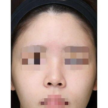 聖心美容クリニックの鼻の症例写真[ビフォー]