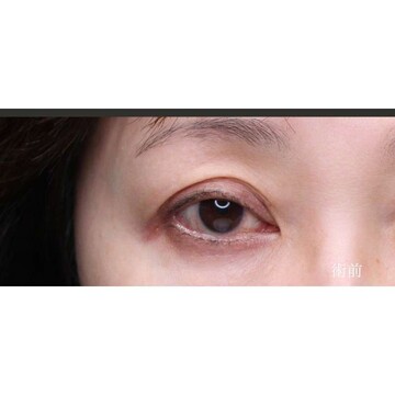 聖心美容クリニックの二重の症例写真[ビフォー]