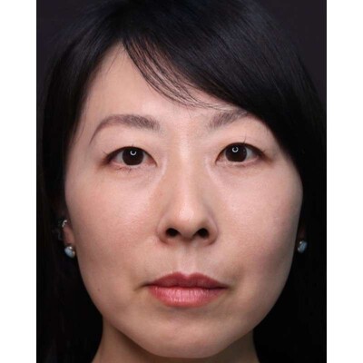 裏ハムラ法で強い目元の影を根本から改善（術後3ヶ月）の症例写真[アフター]