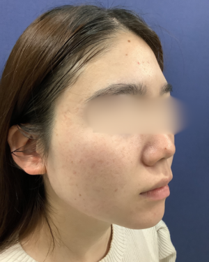 フェミークリニックの症例写真[アフター]