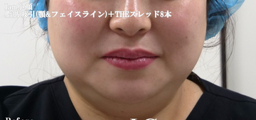 静岡美容外科橋本クリニックの脂肪吸引の症例写真[ビフォー]