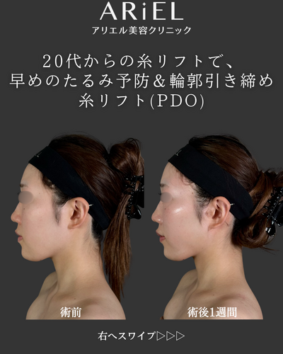 糸リフトの症例写真