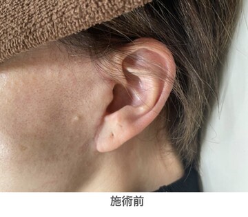 やさしい美容皮膚科・皮フ科 東京浅草院／シミレーザークリニックのその他の美容皮膚科治療の症例写真[ビフォー]