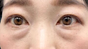 AI Beauty Clinicの目元・クマ・眉下・涙袋整形の症例写真[ビフォー]