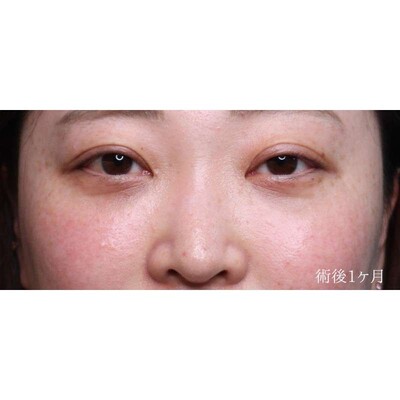 裏ハムラ法でふくらみと凹みの影を解消（術後1ヶ月）の症例写真[アフター]