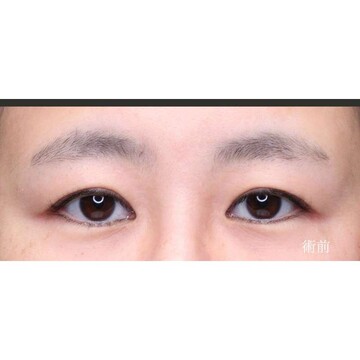聖心美容クリニックの二重の症例写真[ビフォー]