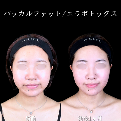 バッカルファット/エラボトックスの症例写真