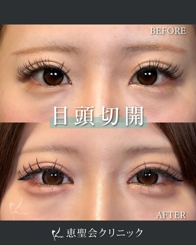 目頭切開の症例写真