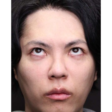 聖心美容クリニックの症例写真[アフター]