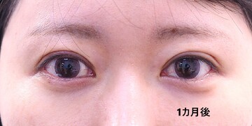 医療法人秀晄会 心斎橋コムロ美容外科クリニックの目・二重整形の症例写真[ビフォー]