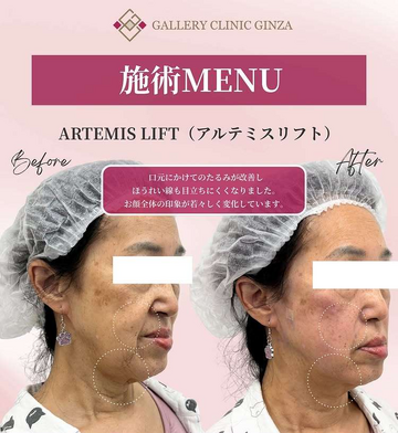 ギャラリークリニックのしわ・たるみ整形(注入、糸、フェイスリフト)の症例写真