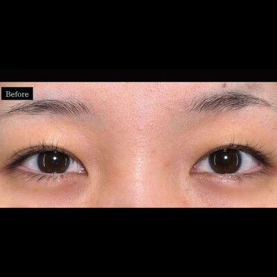 数ミリの違いで印象変わる☺️の症例写真[ビフォー]