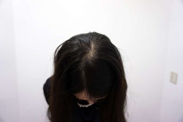 AGAスキンクリニックの薄毛治療の症例写真[ビフォー]