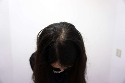 Rebirth+Dr’sメソ｜30代｜12か月の症例写真[ビフォー]
