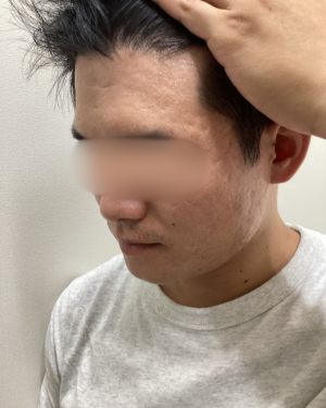 フェミークリニックのニキビ・ニキビ跡の治療の症例写真[ビフォー]