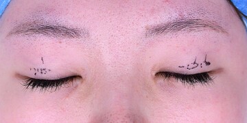 医療法人秀晄会 心斎橋コムロ美容外科クリニックの目・二重整形の症例写真[ビフォー]
