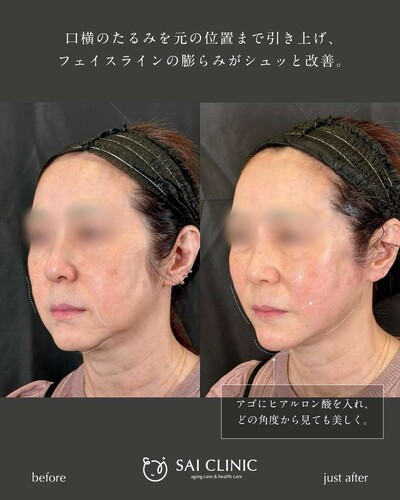 糸リフト：20本＋ヒアルロン酸：1cc（アゴ）の症例写真