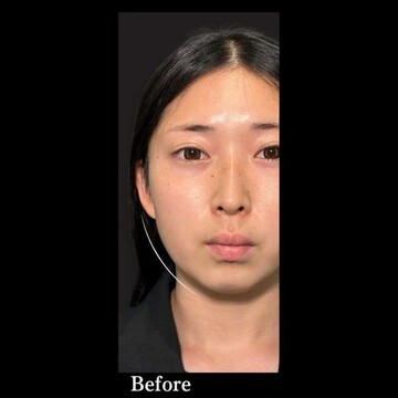 PRISM Beauty Clinicの脂肪吸引の症例写真[ビフォー]