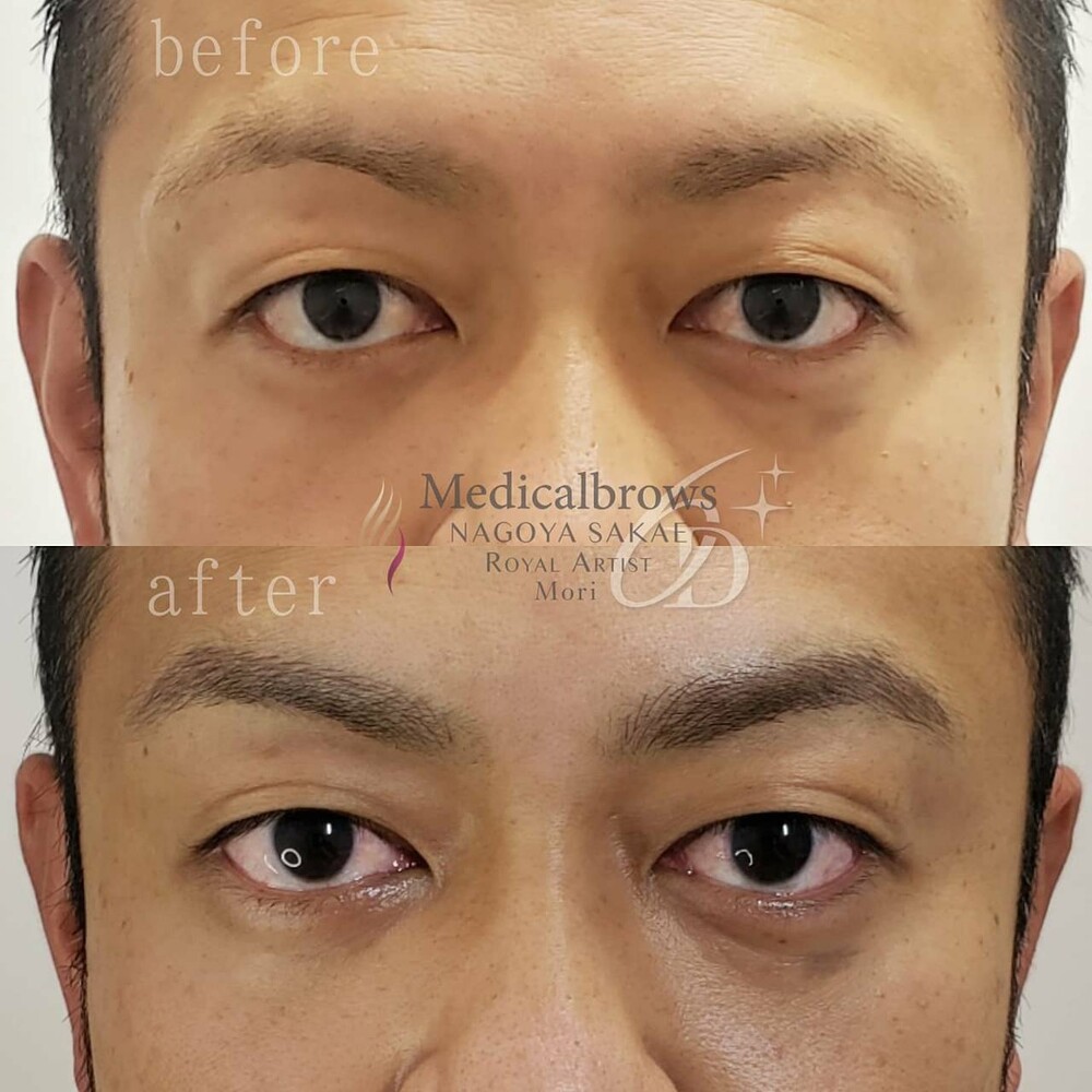 ６dストロークアートメイク 眉 2回 ロイヤルアーティスト アートメイクの症例写真 画像 リアラクリニック 栄院 Cs 美容医療の口コミ広場