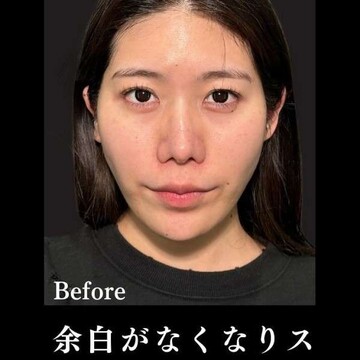 PRISM Beauty Clinicのリフトアップの症例写真[ビフォー]