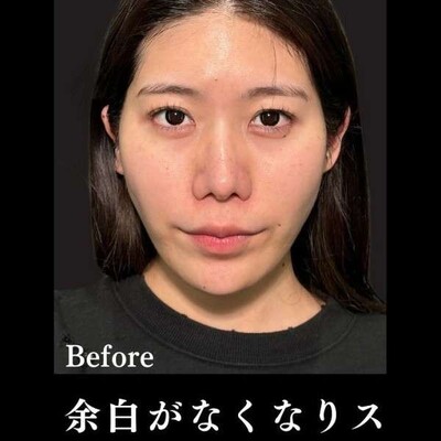 アルテミスリフト10本の症例写真[ビフォー]
