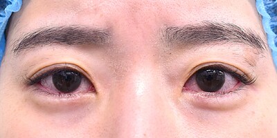 30代　女性　目尻切開　W法　　2.5㎜幅の症例写真[ビフォー]
