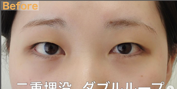 さかえ皮フ科クリニック（旧：ニドークリニック名古屋）の目・二重整形の症例写真[ビフォー]