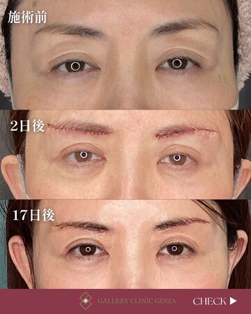 ギャラリークリニックの目元・クマ・眉下・涙袋整形の症例写真