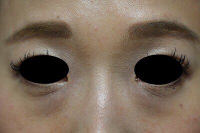 涙袋のヒアルロン酸注入 涙袋形成の症例写真 画像 あきこクリニック Cs 美容医療の口コミ広場