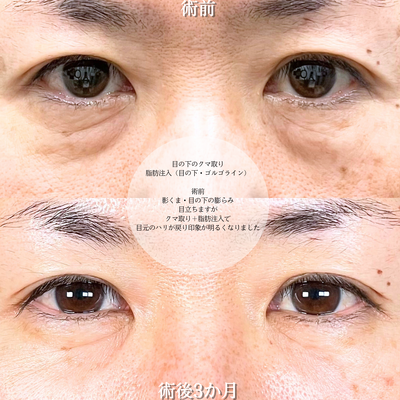 目の下のたるみ取り・クマ取り/脂肪注入の症例写真