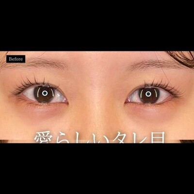愛らしい目元って？🥺の症例写真[ビフォー]