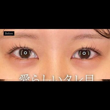 PRISM Beauty Clinicの目元の症例写真[ビフォー]