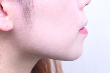 医療法人秀晄会 心斎橋コムロ美容外科クリニックの症例写真[アフター]