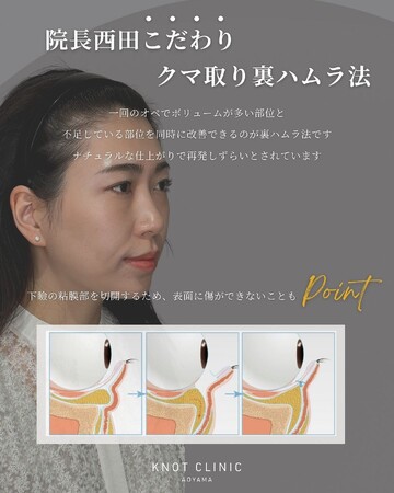 KNOT CLINIC AOYAMAの目元・クマ・眉下・涙袋整形の症例写真