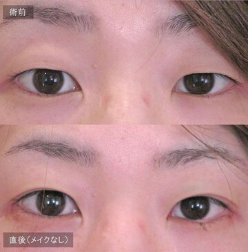 アーティスクリニックの目・二重整形の症例写真