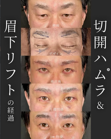 SAI CLINIC （サイクリニック）の目元・クマ・眉下・涙袋整形の症例写真