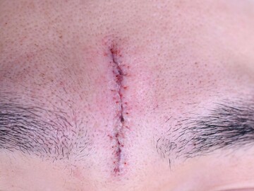 医療法人秀晄会 心斎橋コムロ美容外科クリニックのしわ・たるみ整形(注入、糸、フェイスリフト)の症例写真