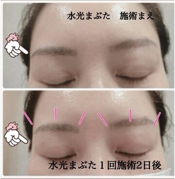 やさしい美容皮膚科・皮フ科 東京浅草院／シミレーザークリニックの目元・クマ・眉下・涙袋整形の症例写真