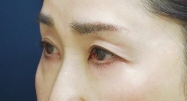 下まぶたのたるみ⼿術（表ハムラ法）の症例写真[アフター]