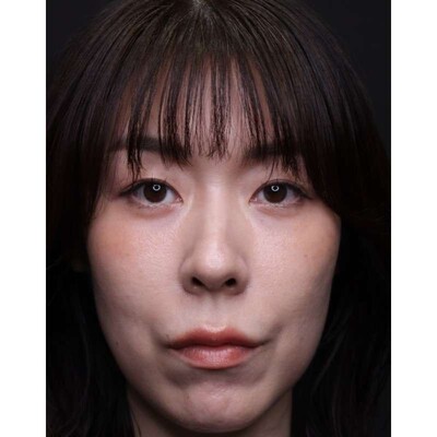 裏ハムラ法で疲れ顔の原因の影を改善（術後1ヶ月）の症例写真[アフター]