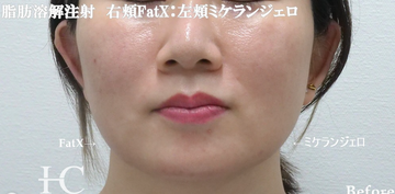 静岡美容外科橋本クリニックの再生医療・美容点滴の症例写真[ビフォー]