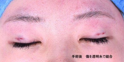 20代　女性　埋没糸抜去　計8本の症例写真[アフター]