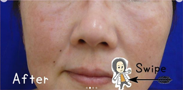 ピコレーザー＆ゼオスキンの症例写真[アフター]