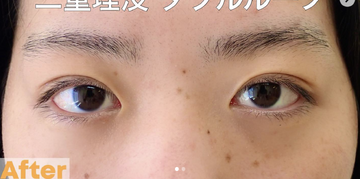 さかえ皮フ科クリニック（旧：ニドークリニック名古屋）の症例写真[アフター]