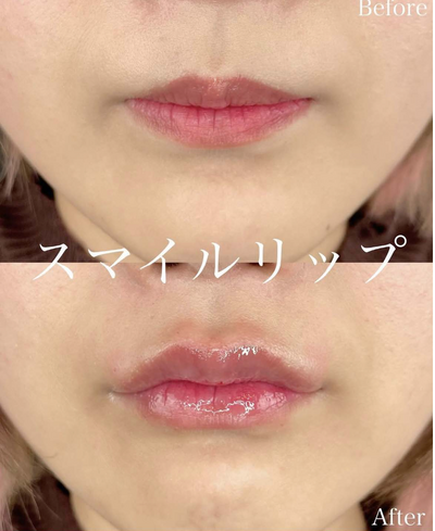 スマイルリップの症例写真