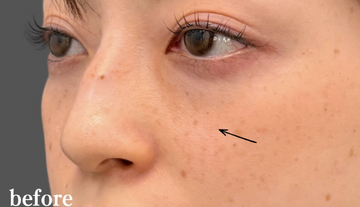 Plume Clinicの目元・クマ・眉下・涙袋整形の症例写真[ビフォー]